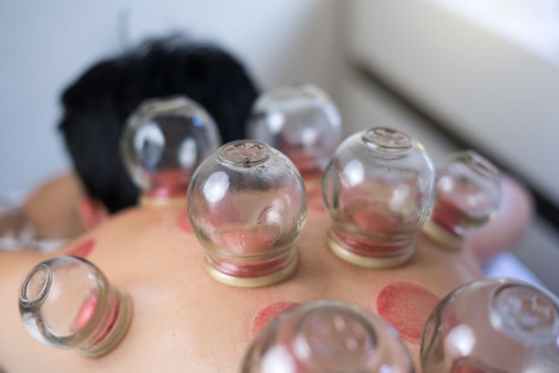 Cupping